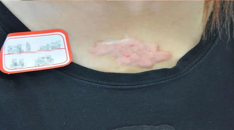 警惕!为什么胸前是疤痕疙瘩的重灾区?居然是这