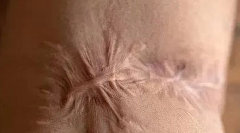 疤痕自测，看看你属于哪一种疤痕?该怎么治疗