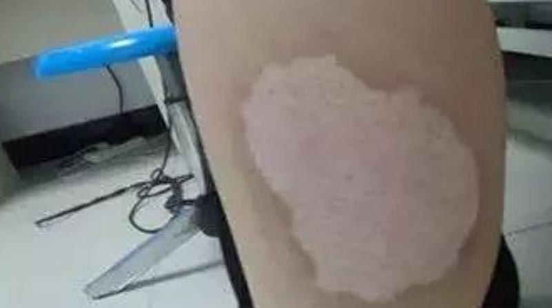 【科普时间】色脱疤痕还能恢复到正常肤色吗?