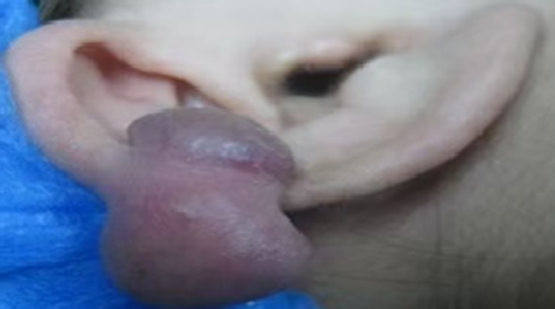 疤痕疙瘩恶化有什么症状