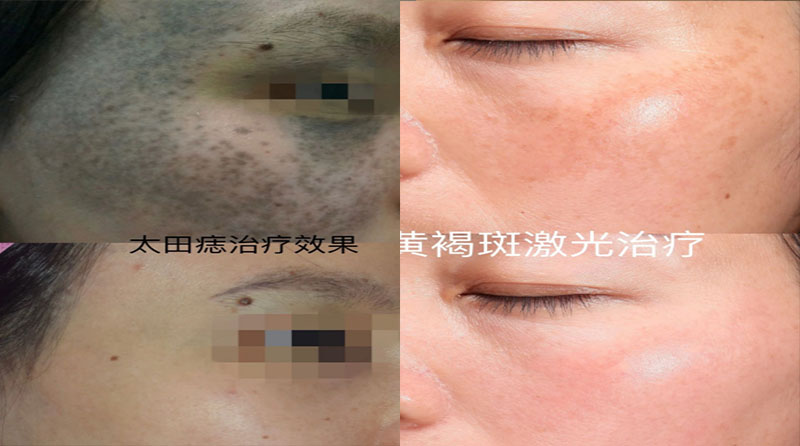 色斑治疗：综合方法，科学应对