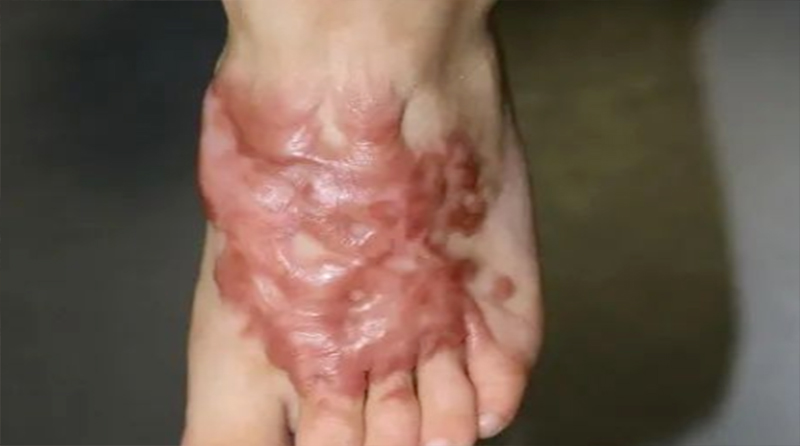 一觉醒来掉了一块皮！真的别再小瞧低温烫伤了