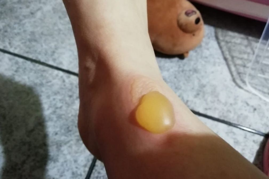 .低温烫伤为什么不能被重视?