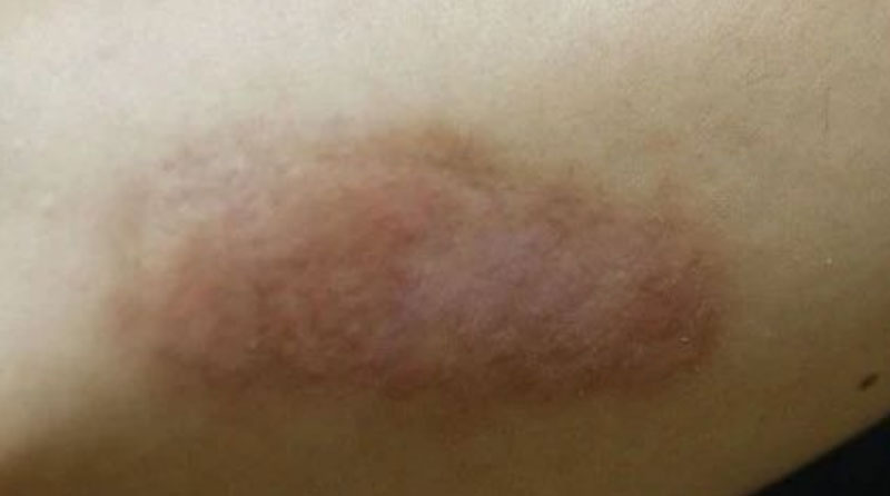 掉痂后科学护理全攻略：从基础到进阶，彻底告