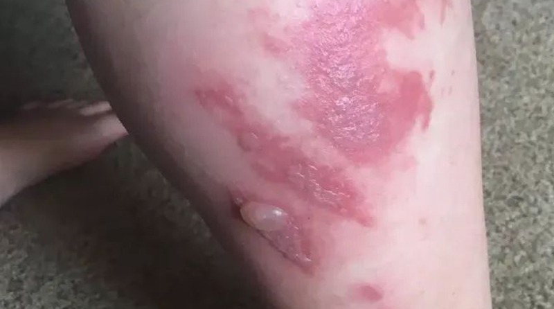 烧伤后瘢痕分类有哪几种