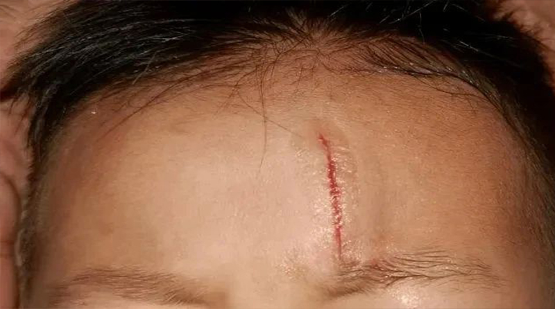 孩子擦伤割伤这样做恢复快少留疤