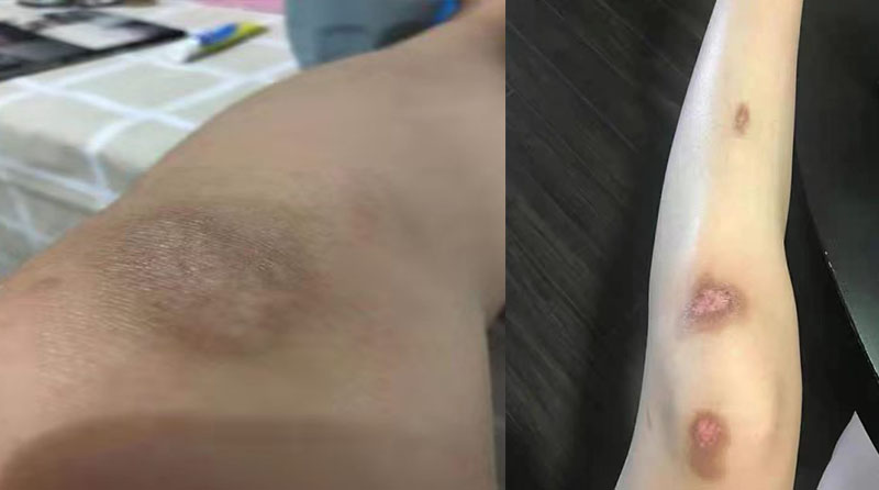 碘伏擦伤口会留色沉？皮肤科医生教你科学应对