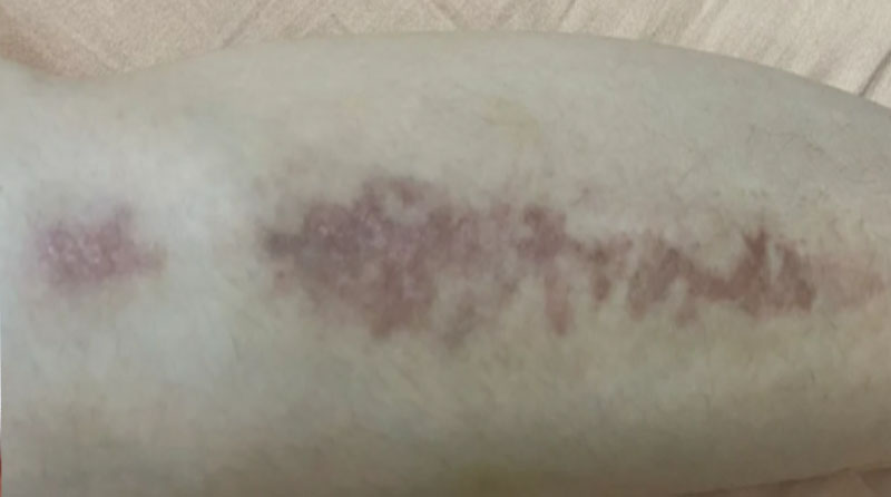 夏季防晒全攻略：科学防护，远离色素疤痕困扰