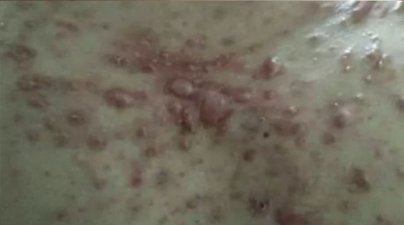 告别“小疙瘩”焦虑：非手术疗法全攻略，在家