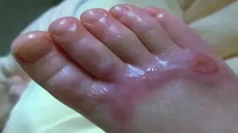 烫伤后如何预防疤痕