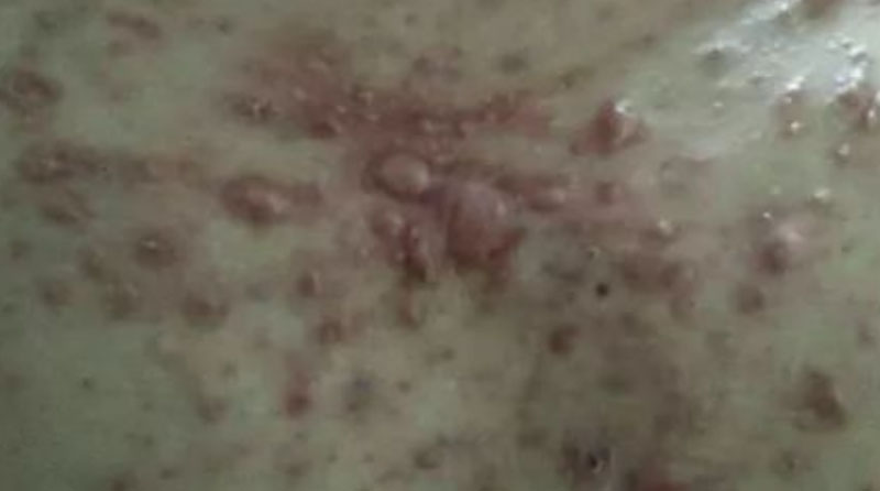 疤痕疙瘩红肿发痒的原因及缓解方法