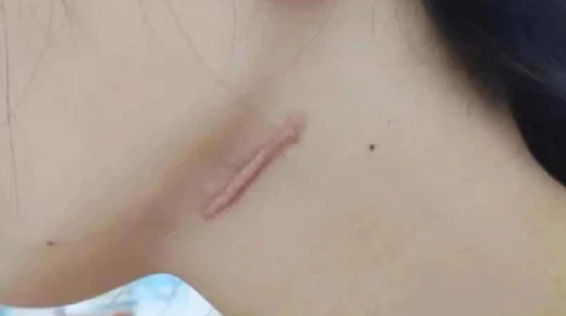 甲状腺手术刀疤怎么去除