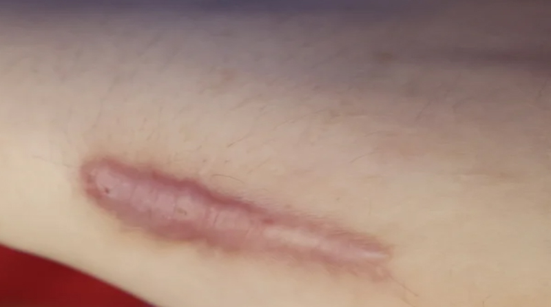 疤痕体质者如何避免物理刺激