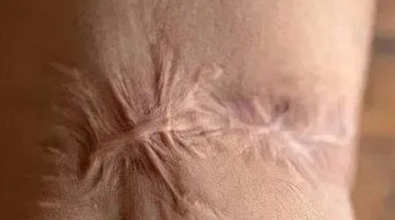 烧烫伤后为何会形成挛缩性疤痕或增生性疤痕？