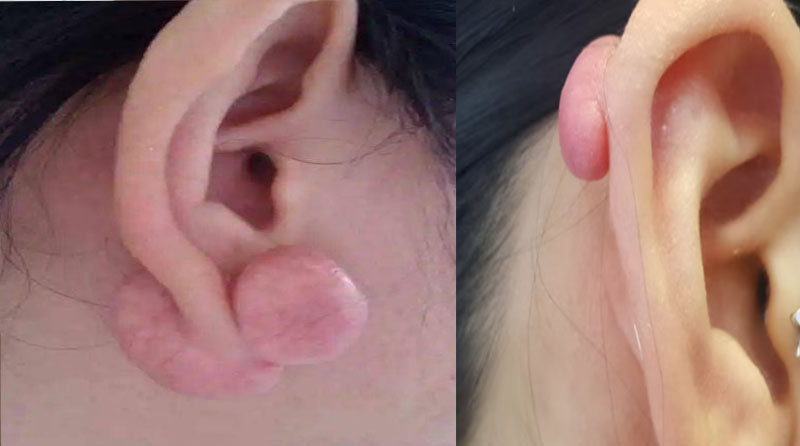 哪些部位点痣容易留疤？——深度科普解